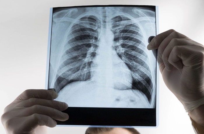 Cerveza y salud pulmonar